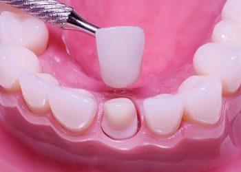 Bọc Răng Sứ Cho Răng Mọc Lệch Có Hiệu Quả Không? Chi Phí Cụ Thể?
