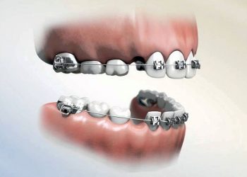 Niềng răng nhổ răng số 4 có gây nguy hiểm không? Cùng tìm hiểu ngay