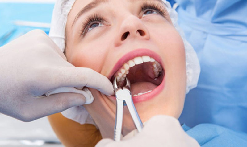 Lựa chọn cơ sở uy tín để niềng răng và nhổ răng số 4