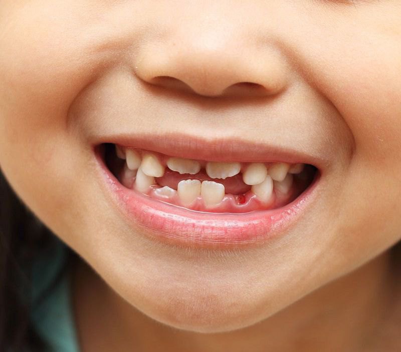 Răng sữa mọc lệch là tình trạng khá phổ biến ở trẻ nhỏ