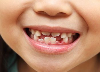 Nhổ răng sữa mọc lệch cho trẻ cần được thực hiện ở nha khoa