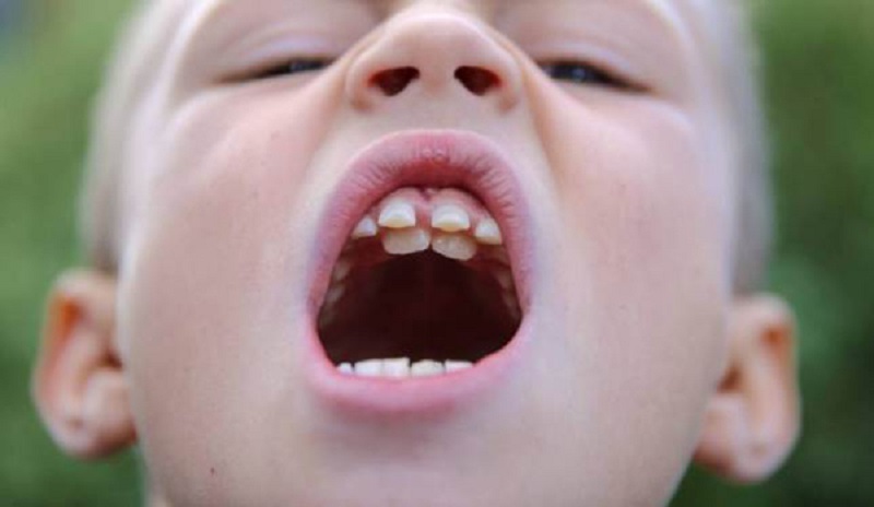 Do các thói quen xấu từ nhỏ có thể khiến răng mọc lệch vào trong
