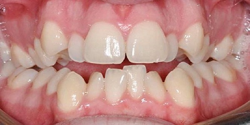 Hạn chế các thói quen xấu, thường xuyên đi khám nha khoa để giúp con trẻ phát triển hàm răng bình thường
