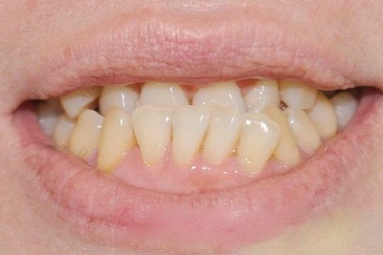 Răng mọc lệch vào trong và cách xử lý