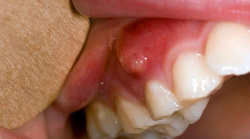 Áp xe răng không chỉ gây đau nhức mà còn tiềm ẩn biến chứng nguy hiểm