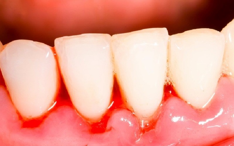 Chảy máu nướu răng là dấu hiệu cảnh báo cho các bệnh lý nguy hiểm 