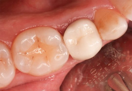 Răng hàm là nhóm răng quan trọng trên cung hàm