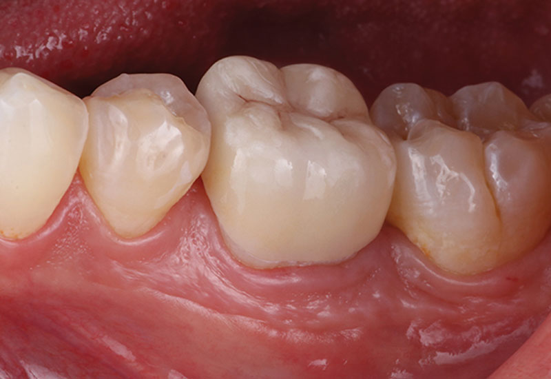 Răng hàm là những chiếc răng lớn nhất trên cung hàm