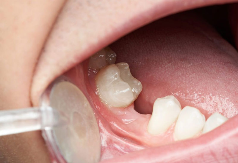 Nguyên nhân phổ biến nhất dẫn đến mất răng hàm là do các bệnh lý răng miệng