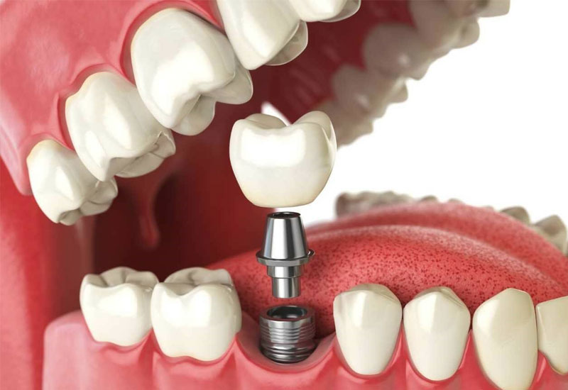 Hình ảnh mô tả phương pháp trồng răng Implant
