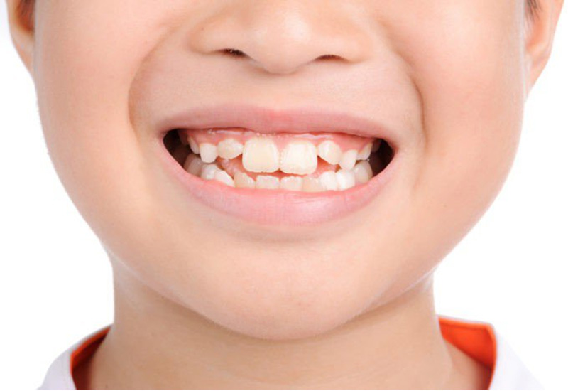 Răng trẻ có thể mọc lệch do nhiều nguyên nhân