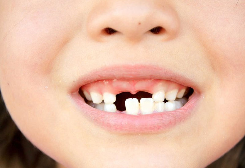 Răng sữa bị mất do chấn thương cũng có thể ảnh hưởng đến quá trình mọc răng vĩnh viễn