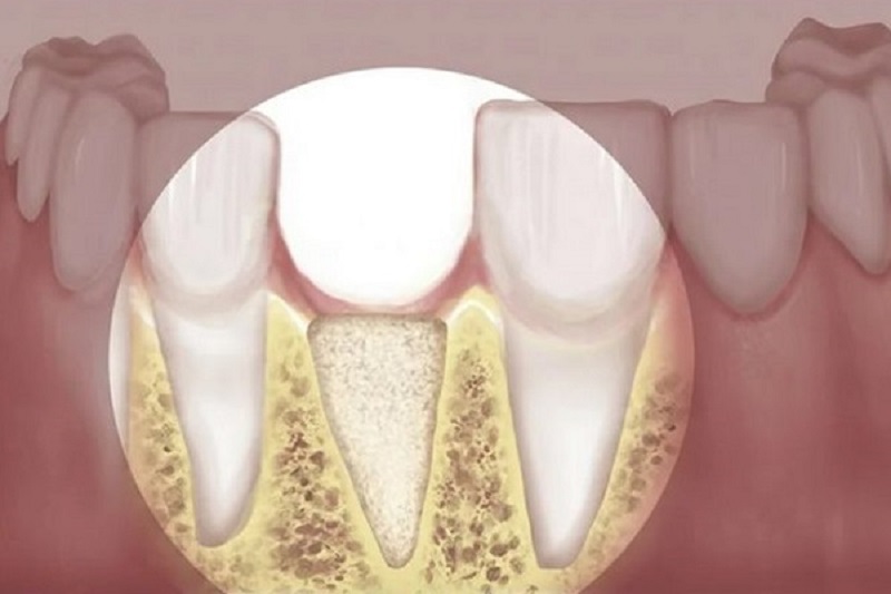 Nướu răng bị sưng có thể dẫn tới tiêu xương hàm nếu không được xử lý kịp thời