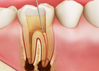 Viêm Tủy Răng: Nguyên Nhân, Triệu Chứng Và Gợi Ý Cách Chữa