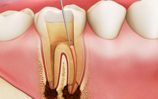 Viêm Tủy Răng: Nguyên Nhân, Triệu Chứng Và Gợi Ý Cách Chữa