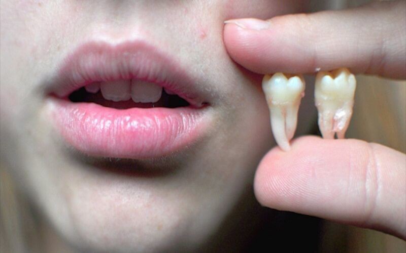 Nhổ răng khôn nên được tiến hành tại các nha khoa uy tín, chất lượng