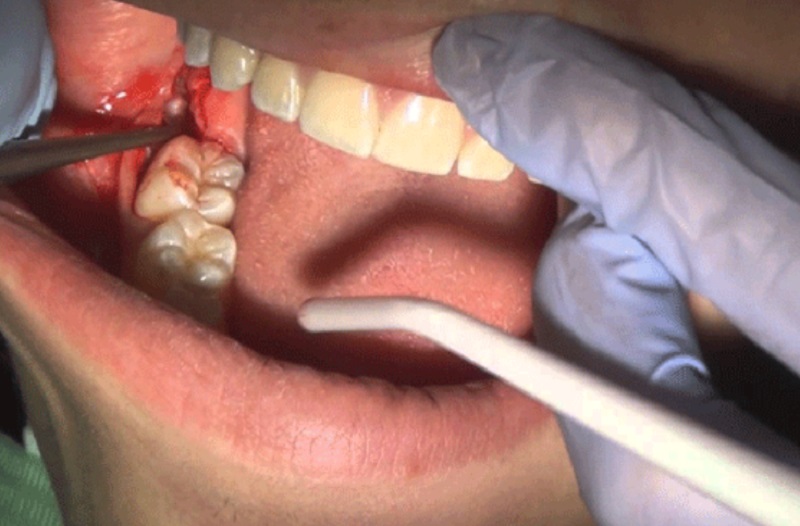 Nhổ răng khôn mọc lệch có đau không phụ thuộc vào tay nghề bác sĩ