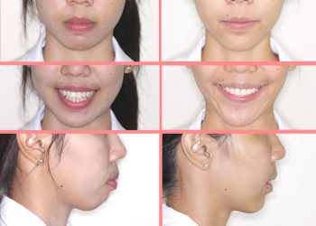 Trường hợp niềng răng thành công tại ViDental