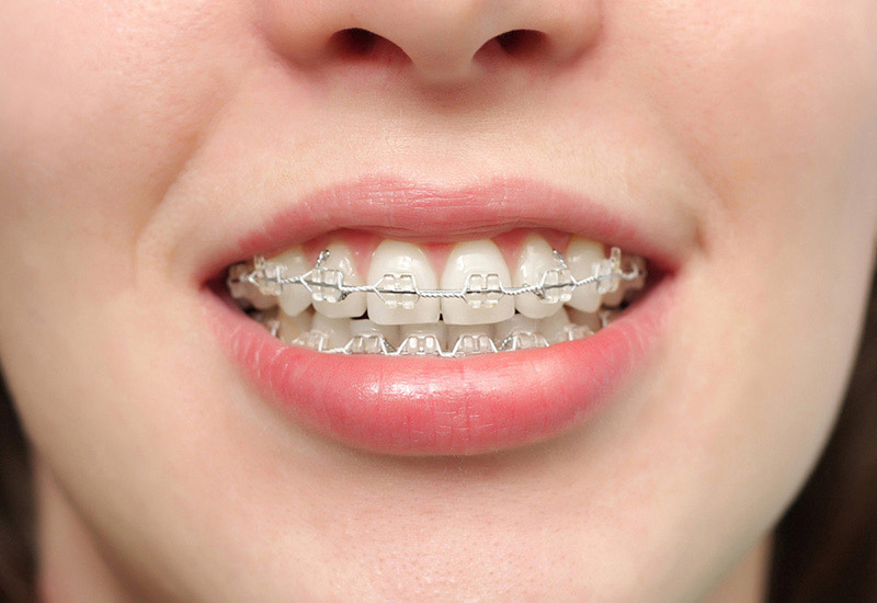 bảng giá niềng răng mắc cài pha lê Niềng răng mắc cài pha lê là phương pháp chỉnh nha sử dụng mắc cài bằng pha lê