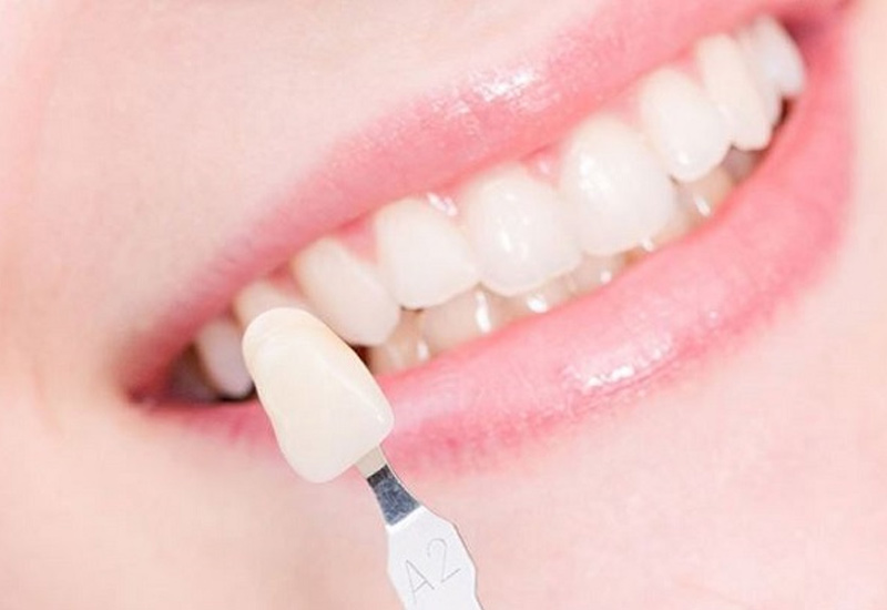 Phương pháp dán sứ veneer không gây đau hoặc ê buốt răng