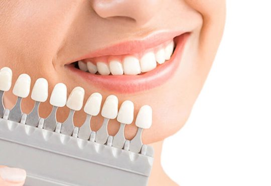 [Giải Đáp] Dán Sứ Veneer Có Tốt Không Và Các Lưu Ý Quan Trọng Khác?