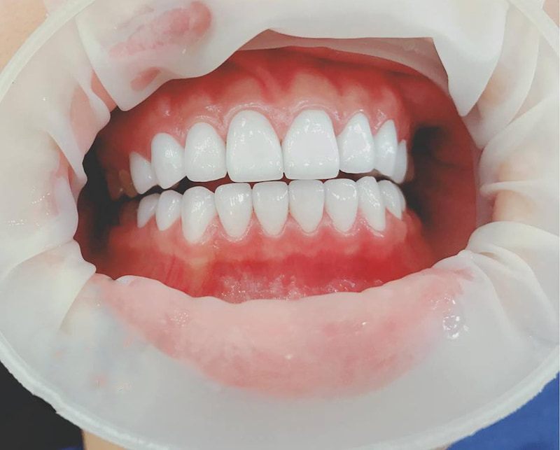 Dán sứ Veneer sẽ giúp bạn có một hàm răng hết ố màu, tăng tính thẩm mỹ cho khuôn miệng