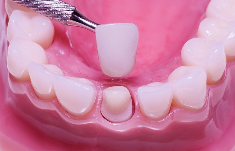 Phương pháp bọc răng sứ giúp bạn nhanh chóng có được hàm răng đều đẹp