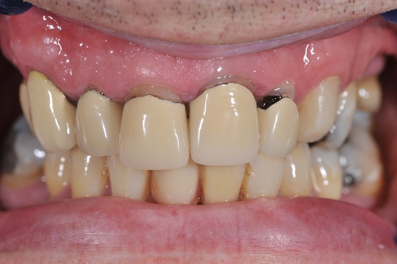 Khi răng sứ bị cộm, chắc chắn sẽ ảnh hưởng rất nhiều đến yếu tố thẩm mỹ