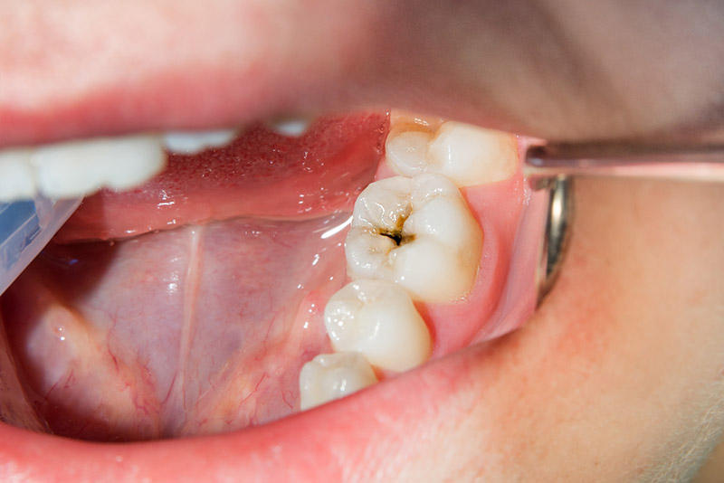Tình trạng răng miệng cũng có thể khiến giá bọc sứ cho răng hô thay đổi