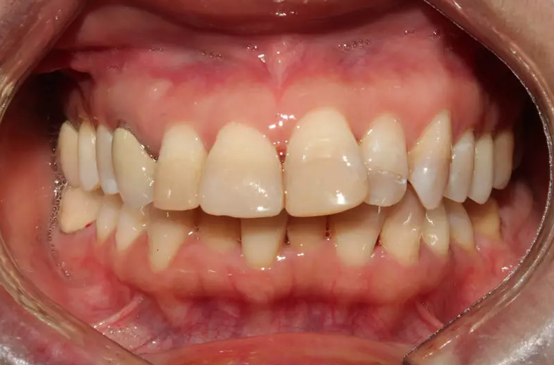 Răng không đều hoặc bị nhiễm vàng có thể sử dụng bọc sứ Nano Shining 5S để khắc phục 