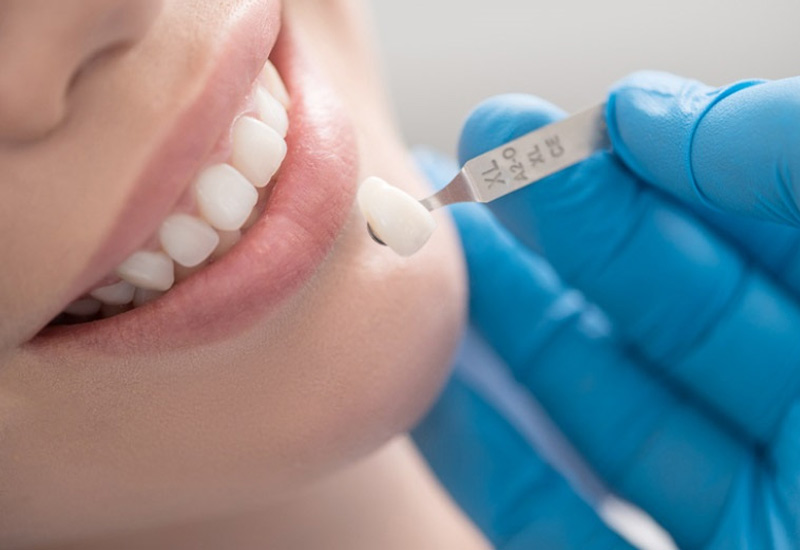 Tùy vào loại răng sứ mà bạn chọn, mức chi phí sẽ khác nhau