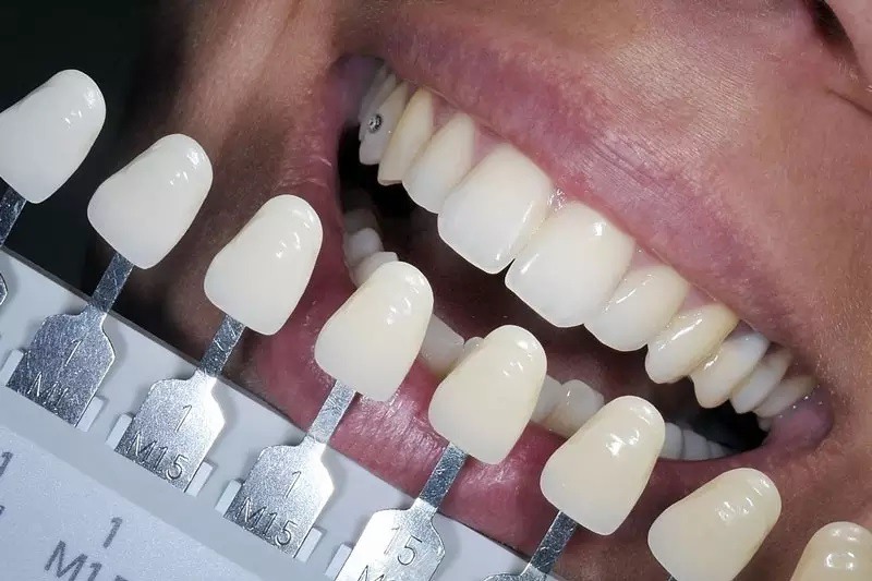 Chi phí bọc răng sứ cho răng hô sẽ phụ thuộc vào loại sứ mà bạn chọn