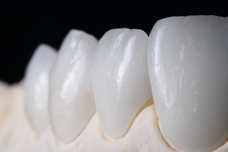Răng sứ Cercon là một trong những loại răng giả chất lượng