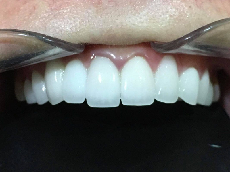 Bọc răng sứ Titan giá bao nhiêu là thắc mắc chung của nhiều khách hàng