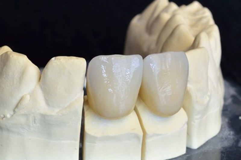 Răng sứ Venus được sử dụng phổ biến trong nha khoa thẩm mỹ