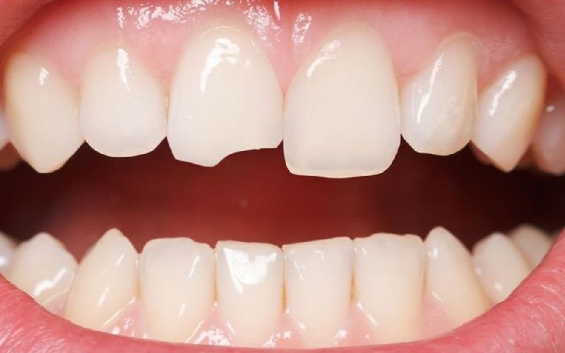 Trường hợp răng sứt mẻ có thể dùng răng sứ Zirconia thay thế