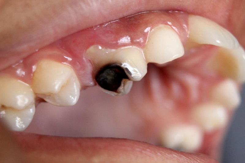 Có nhiều nguyên nhân gây sâu răng trong đó chủ yếu do vi khuẩn