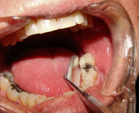 Sâu Răng Ăn Vào Tủy: Dấu Hiệu Nhận Biết Và Cách Điều Trị An Toàn