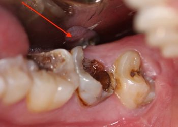 sâu răng số 6 cực kì nguy hiểm và có thể gây nên nhiều biến chứng