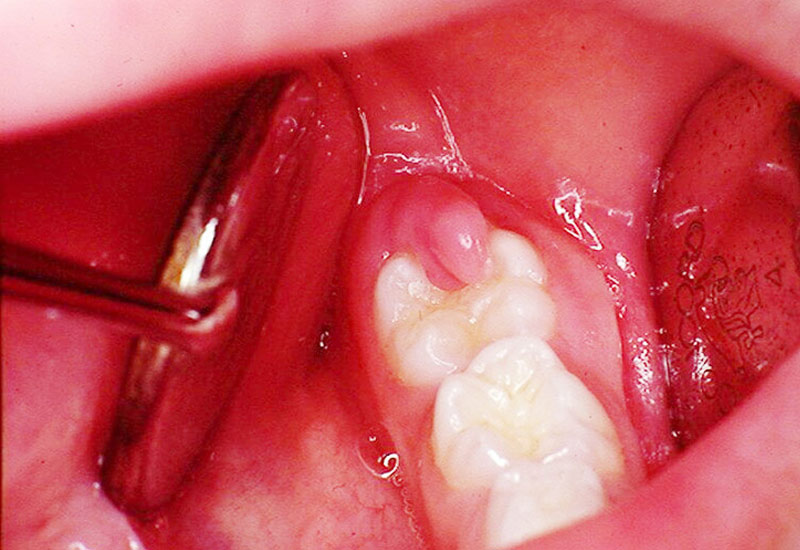 Dấu hiệu của viêm lợi trùm răng khôn khá dễ nhận thấy