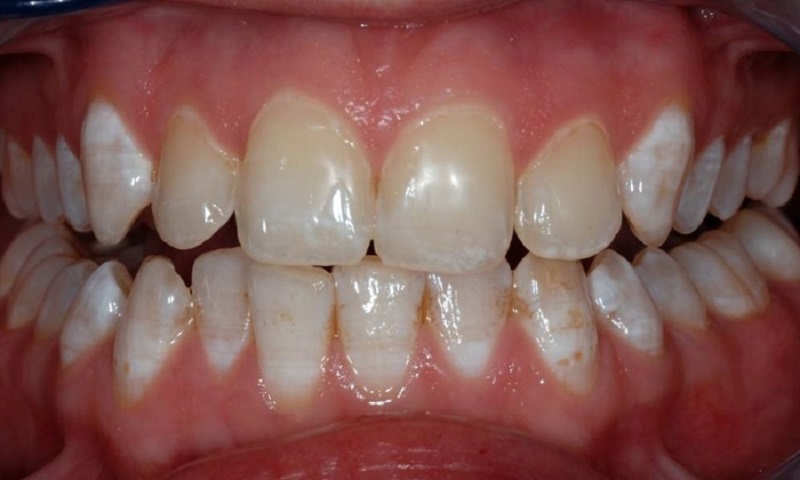 Răng nhiễm fluor là tình trạng có thể gặp ở bất cứ ai