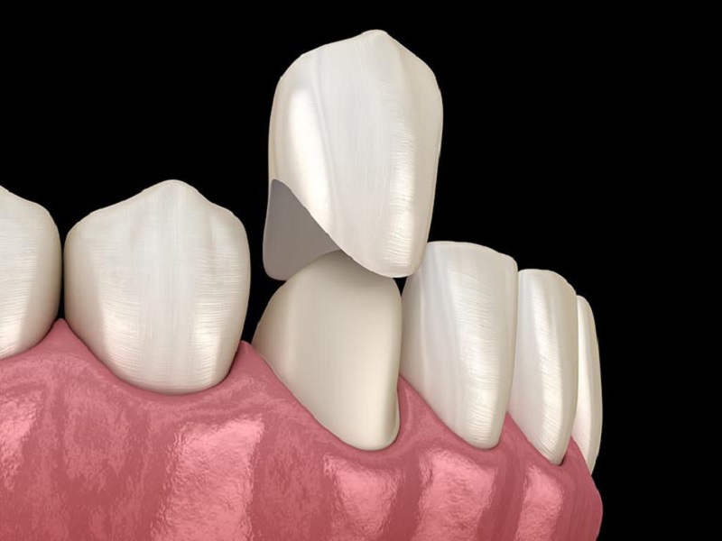 Bọc răng sứ giúp khắc phục hỏng men răng hiệu quả