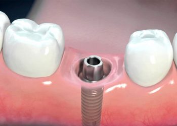 Tiết Lộ 16 Ưu - Nhược Điểm Của Trồng Răng Implant Ít Người Biết