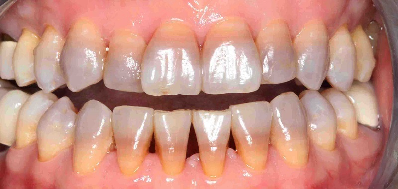 Răng bị xỉn màu là hiện tượng màu răng bị thay đổi và rất dễ nhận biết