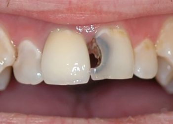 Cách điều trị răng bị đen ở kẽ