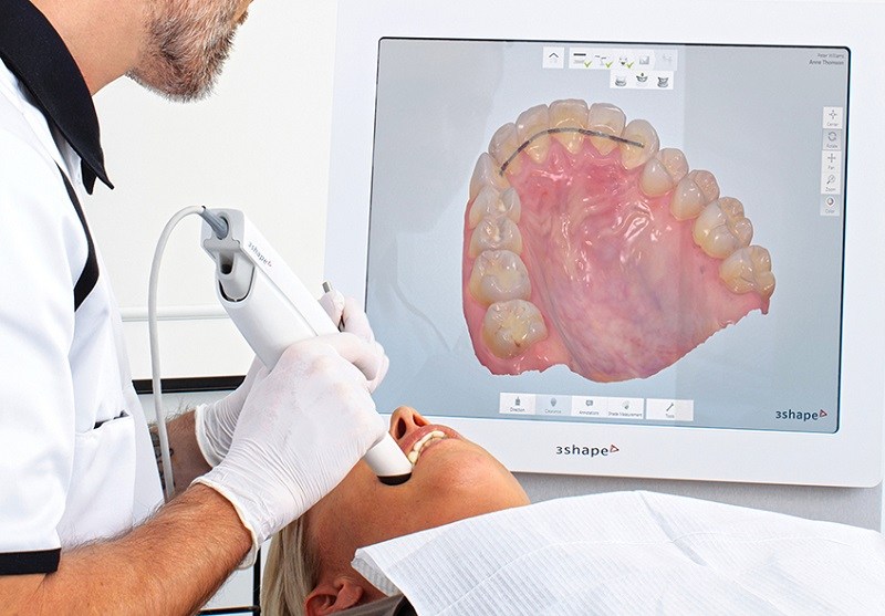 Scan răng 3D sử dụng ánh sáng quét hình ảnh kỹ thuật số trong khoang miệng 