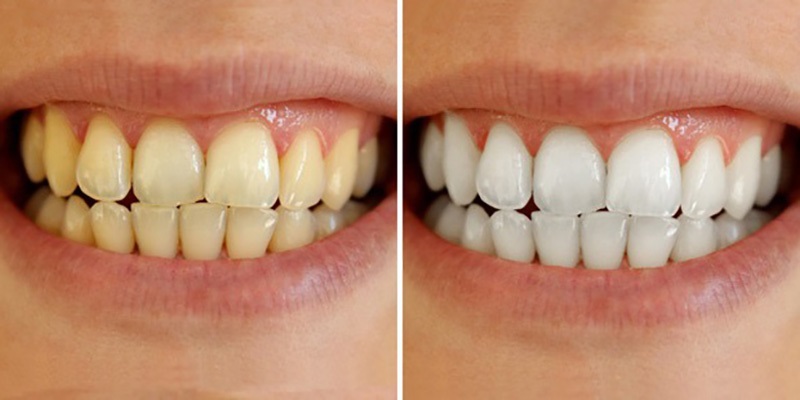 Tẩy trắng răng tại nhà bằng máng là phương pháp được nhiều người quan tâm và sử dụng