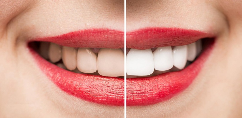 Với những người mong muốn có hàm răng trắng sáng thì có thể áp dụng phương pháp này