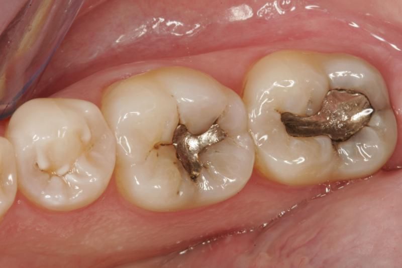 Tình trạng sức khỏe răng miệng cũng ảnh hưởng tới chi phí trồng răng nhai