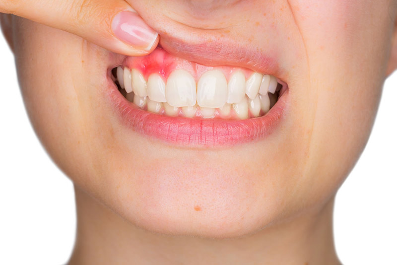 Dấu hiệu của tình trạng viêm nướu răng sứ